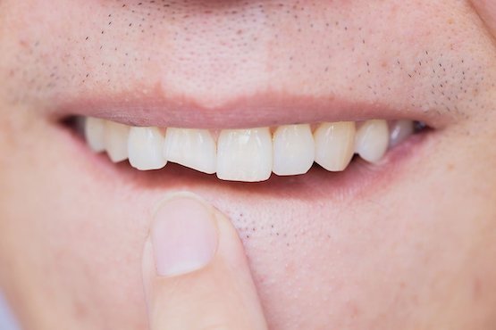 broken-tooth-blurb-leichhardt